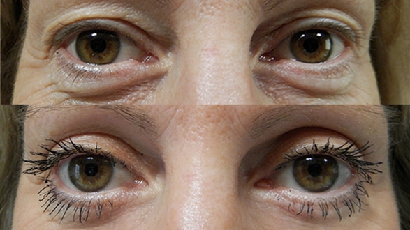 blepharoplasty_7