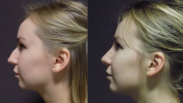 rhinoplastika_1