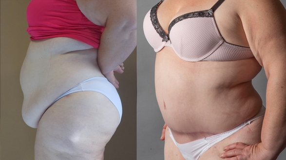 Tummy Tuck Surgery in Prague