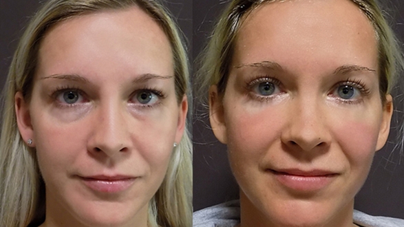 blepharoplasty_6