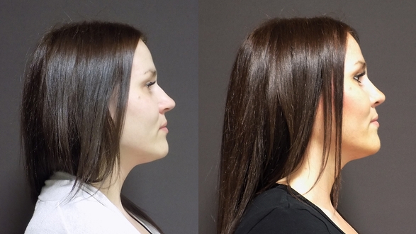 Rhinoplastika