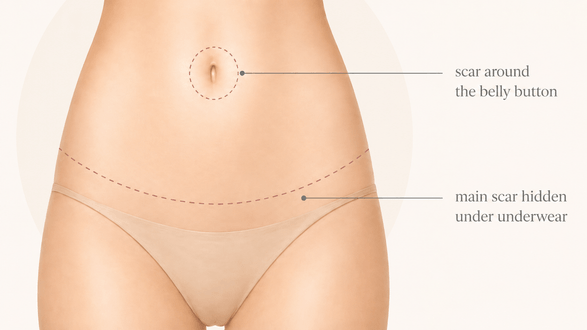 Scars after a tummy tuck during a Mommy Makeover – Formé Clinic Prague