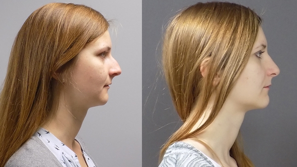 rhinoplastika_operace_nosu_n