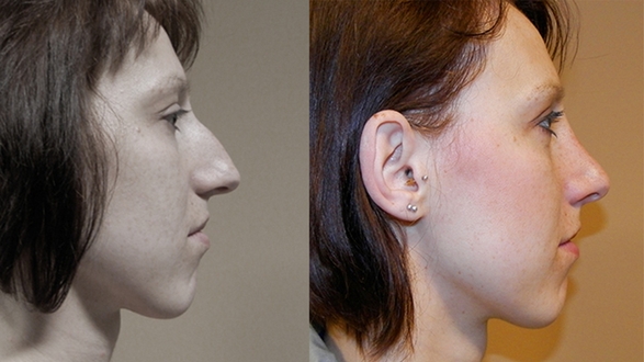 rhinoplastika_9