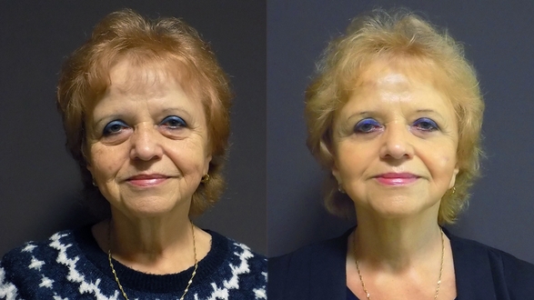 Facelift a necklift 1