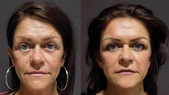 Facelift a necklift 