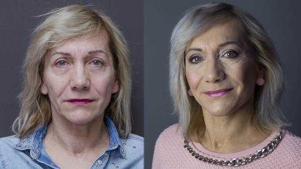 Facelift a necklift