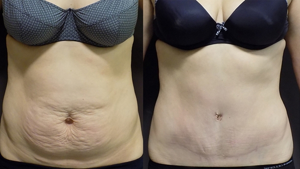 Abdominoplastika_2_1