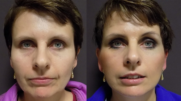 Facelift a necklift 2