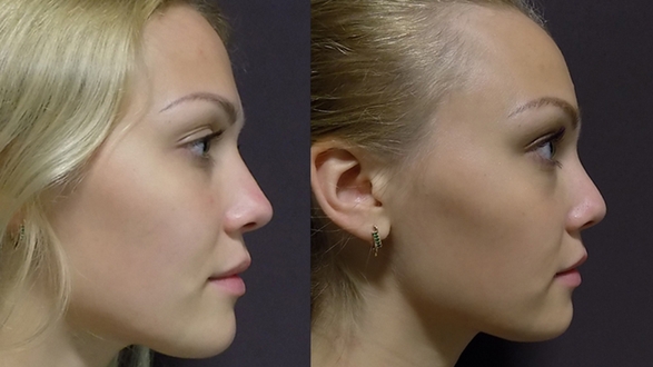 rhinoplastika_3