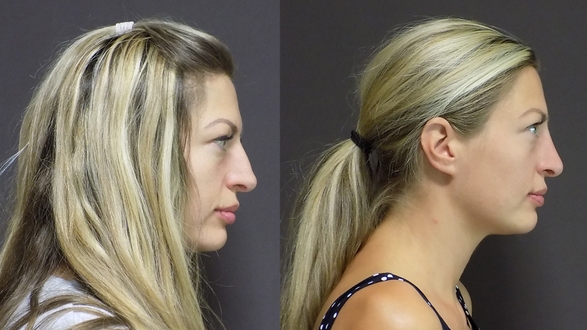 Rhinoplastika