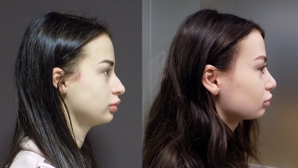 Rhinoplastika_Svitlana-Lepatan