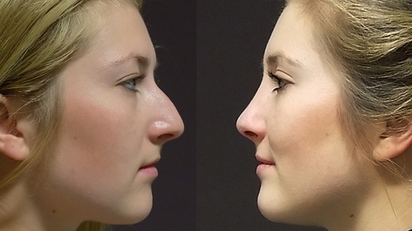 rhinoplastika_2