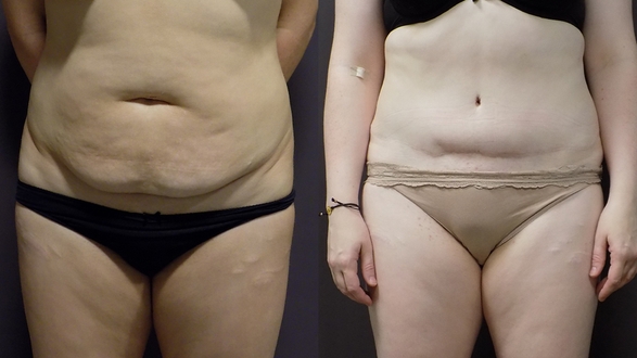 2_Abdominoplastika