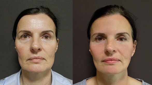 Facelift and necklift · Procedures and operations · Plastic and aesthetic  surgery in Prague · FORMÉ clinic