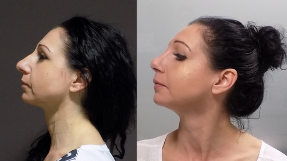 Rhinoplastika_Evgenie_Stancheva