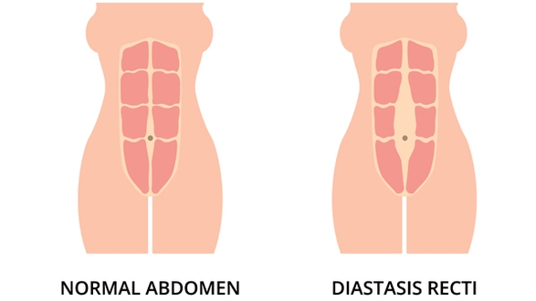 Diastaza