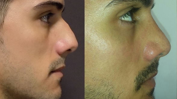 rhinoplastika_5