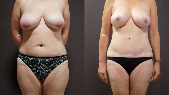 1_Abdominoplastika-s-liposukcí a redukce prsou