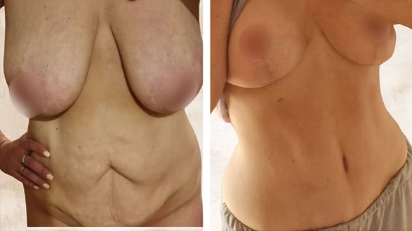 Mommy makeover abdomino 2