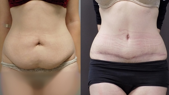 Geula Procházka, abdominoplastika,Dr.Bartošková