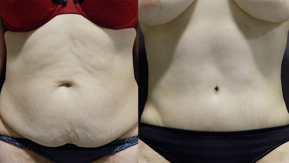 Abdominoplastika_2_2