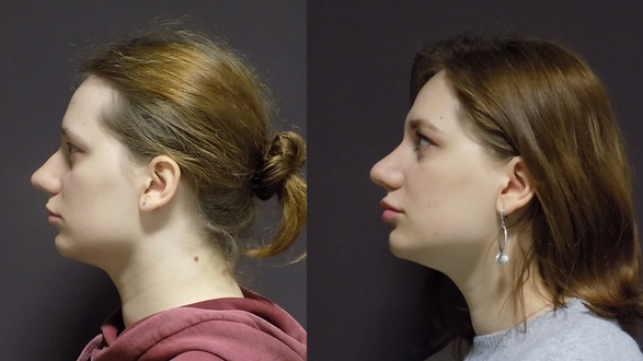 Otevrena Rhinoplastika