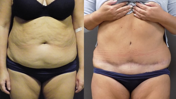 Abdominoplastika Beneš 2019