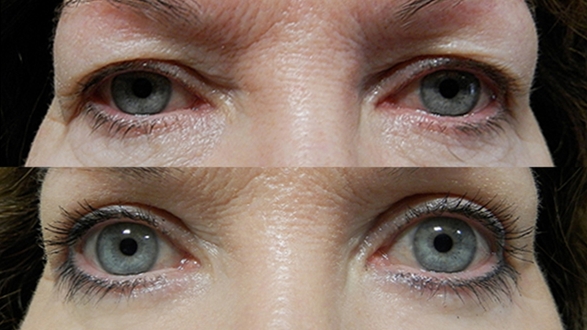 blepharoplasty_8