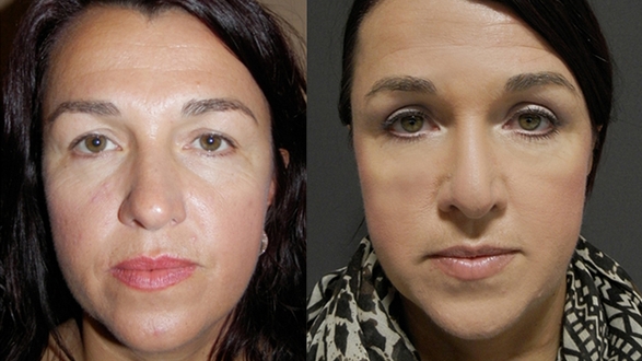 blepharoplasty_5